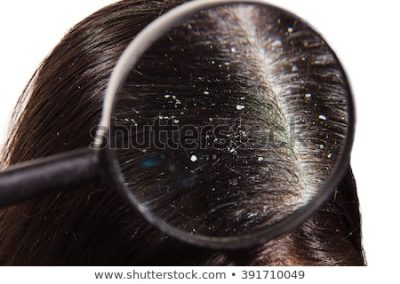 how to get rid of dandruff
